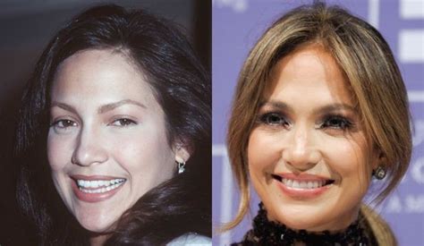 Jennifer Lopez before and after plastic surgery 01 – Celebrity plastic surgery online