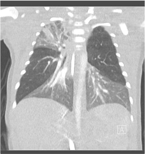 Bilateral Congenital Lobar Emphysema Staged Management Journal Of