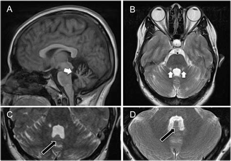 A Sagittal Cross Sectional T1 Weighted Magnetic Resonance Image