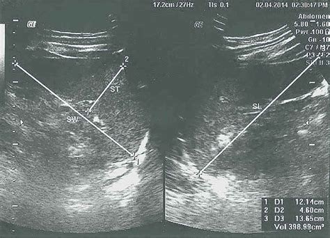 Transverse Spleen Ultrasound