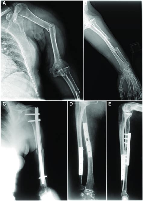 A Initial X Ray Antero Posterior View Of The Arm Displaced Middle