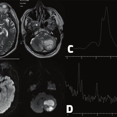 A T2 Weighted Axial Magnetic Resonance Imaging Mri After 3 Weeks