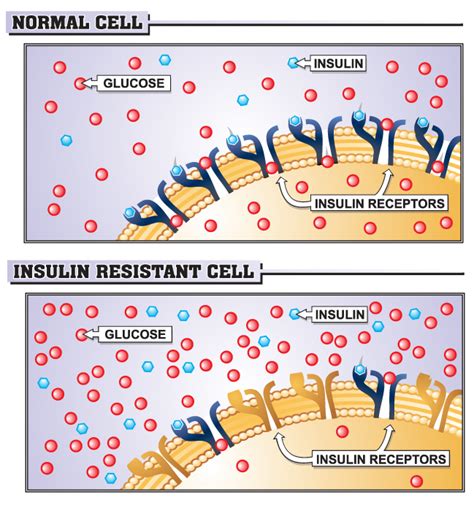 Hiperinsulinemia Y Resistencia A La Insulina