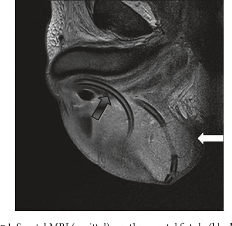 Figure 1 From Scrotal Abscess Drained By Iatrogenic Urethral Fistula In An Adult Diabetic Male