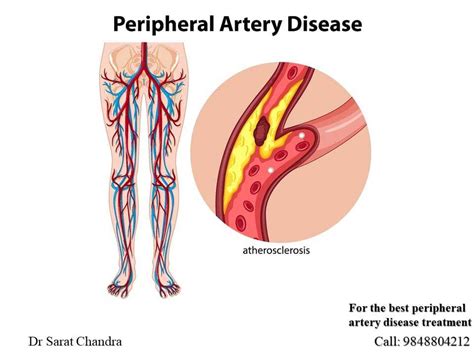 Peripheral Artery Disease Pad Symptoms Treatment 54 Off