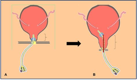 Uro Special Issue Bladder Exstrophy Epispadias Complex Beec Current Management And