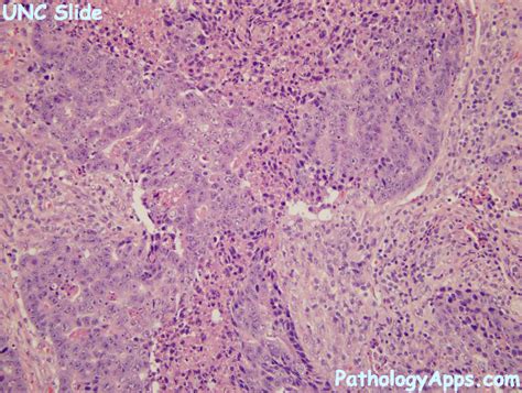 Adenosquamous Carcinoma Pathology