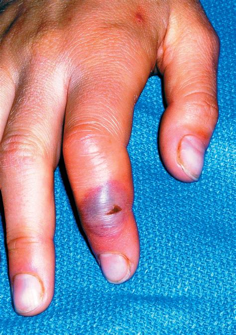 Finger Infection