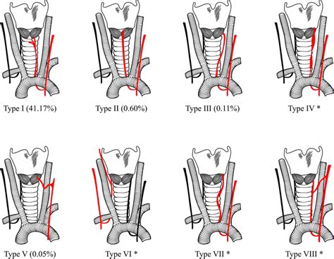 Types Of Anatomical Variations Of The Recurrent Laryngeal Nerve