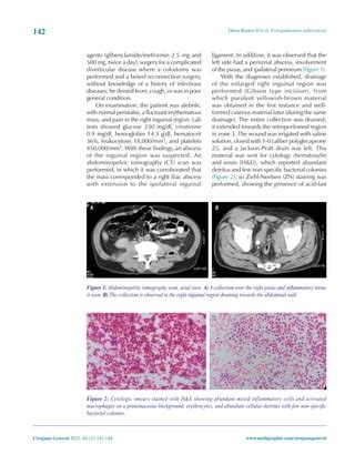 Extrapulmonary tuberculosis presents as a groin abscess | PDF