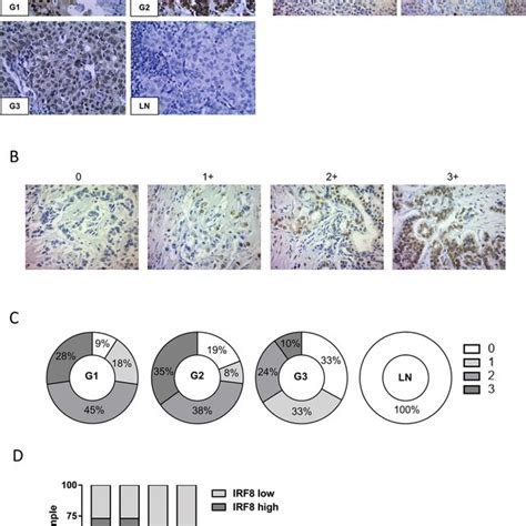 Higher Cancer Cell Irf8 Expression Levels Is Associated With An