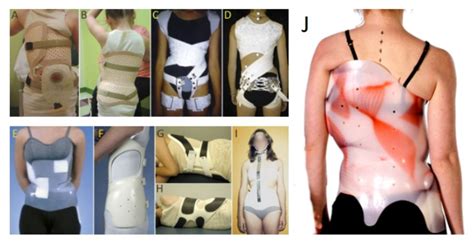 Scoliosis Brace Types Boston Spinecor And Adult Back Braces