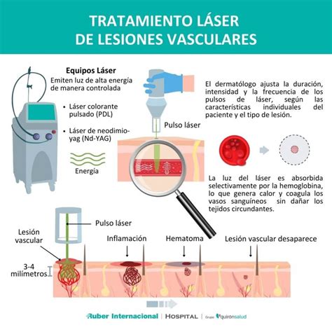 Tratamiento L Ser De Las Lesiones Vasculares Cut Neas Con I De