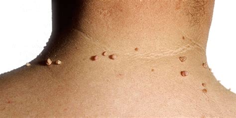 Fibromas Ciruesbelt