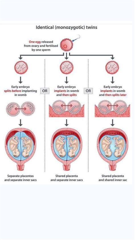 Identical Twins(Monozygotic) | Nursing students, Nursing school humor ...