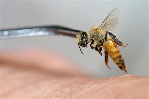 Woman Dies After Undergoing Bee Acupuncture Treatment Famously Touted