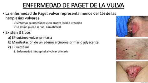 Clase De Patologia Benigna Y Maligna Vulvar Pptx