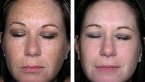 Ipl Photofacial 101 How Does Photorejuvenation Work