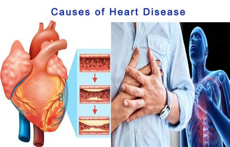 Heart Disease – Definition, Symptoms, Causes, Risk Factors, and More