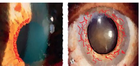 Anatomy Of Iris Topography And Layers Of Iris Insight Ophthalmology