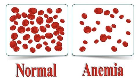 Entendendo A Anemia Causas Sintomas Diagn Sticos E Tratamentos