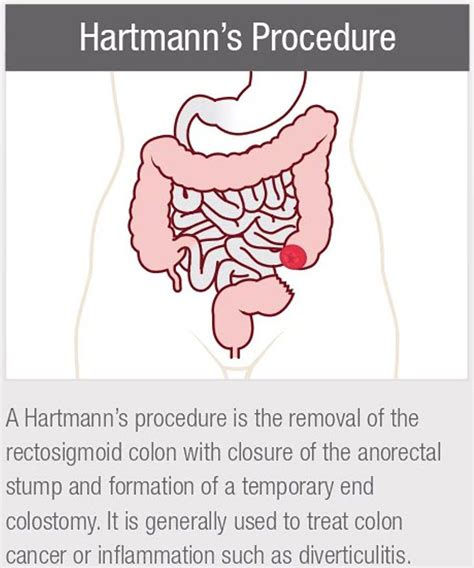 Colostomy Procedure Steps