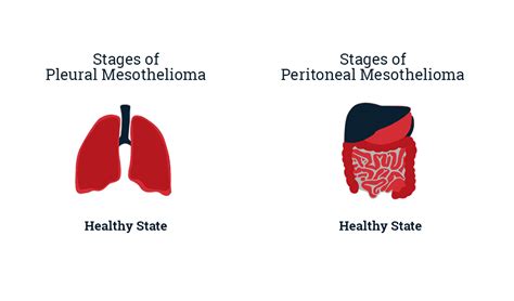 What Is The Difference Between Asbestosis And Mesothelioma Wild Country Fine Arts