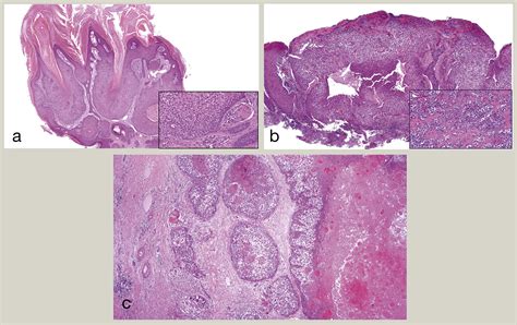 An Overview Of Hair Follicle Tumours Diagnostic Histopathology