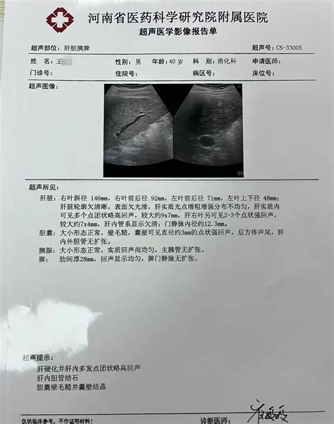 近期接诊的肝硬化患者越来越年轻化 哔哩哔哩