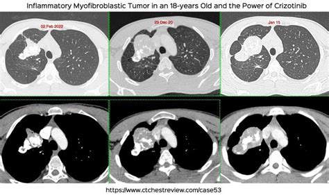 Lung Mass Ct Chest Review