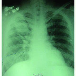 X-ray chest of a patient of aspergilloma in right upper lobe. | Download Scientific Diagram