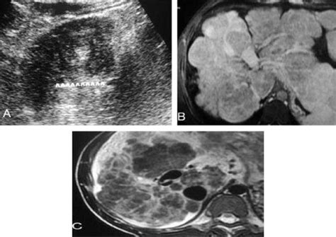 Cirrhotic Liver A Us Large Nodule 5 5cm At Segment 4 B Mri B Download Scientific