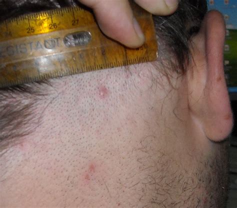 Folliculitis Of The Scalp Pictures Photos