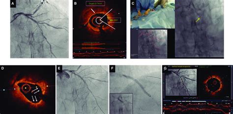 Calcium Modification Using Orbital Atherectomy Guided By Co Registered