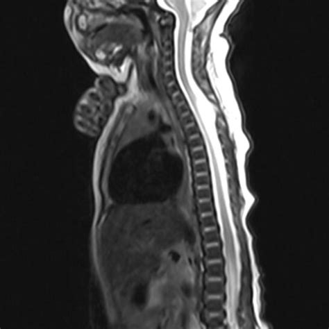 Postoperative Cervical Meningomyelocele Sagittal And Axial MRI