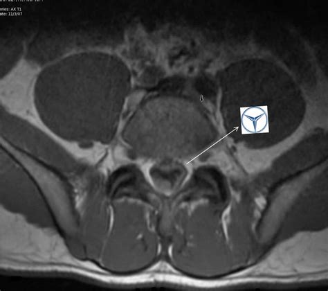 Inverted Mercedes Benz Sign In Lumbar Spinal Subdural Hematoma