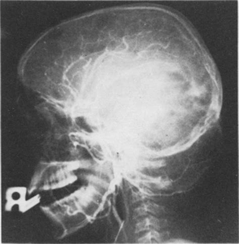 Aneurysmal Bone Cyst Of The Skull In Journal Of Neurosurgery Volume