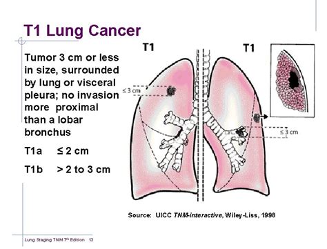 Lung Cancer Tnm Staging Chart