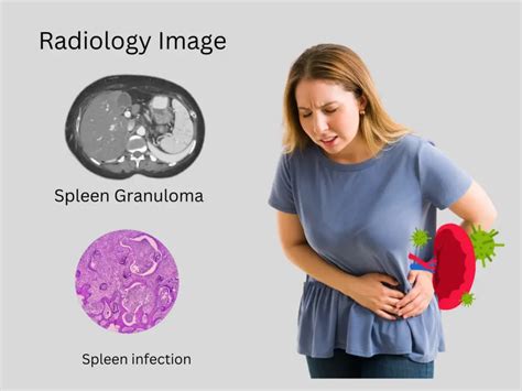 Granulomatous Disease Of The Spleen Symptoms Causes Treatment