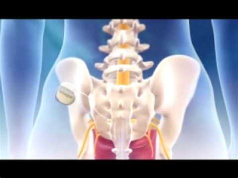 InterStim® Testing Procedure - YouTube