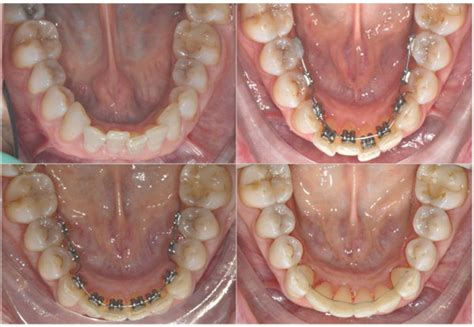 Example Of A Clinical Case Occlusal Views Of The Lower Arch Through