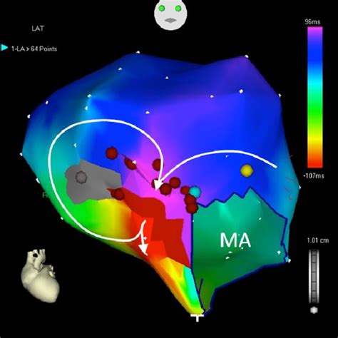 This Figure Shows Electroanatomic Maps In A Patient With Iart Post