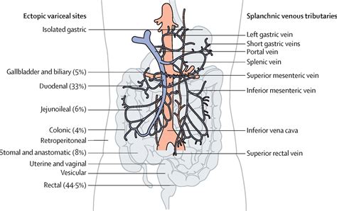 Diagnosis And Management Of Ectopic Varices In Portal Hypertension The Lancet Gastroenterology