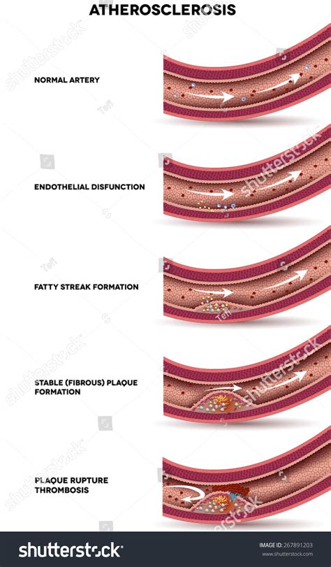 Atherosclerosis Detailed Illustration Atherosclerosis Stages Artery