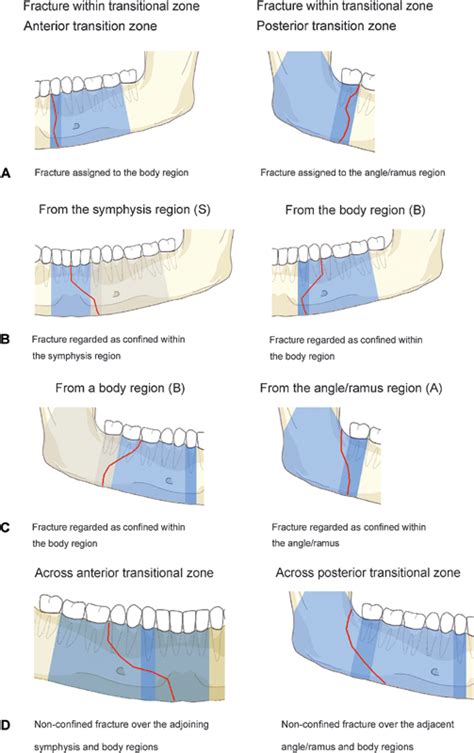 Mandible Fracture Classification