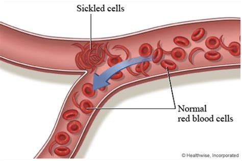 Pediatric Hematology Oncology Flashcards Quizlet