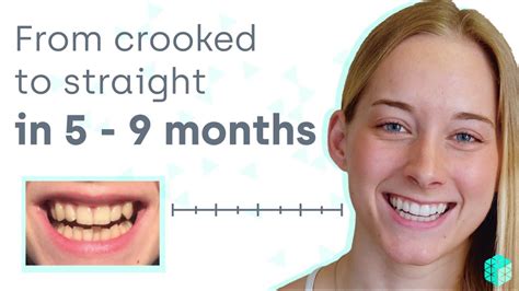 How To Straighten Crooked Teeth Easily And Affordably Without Metal