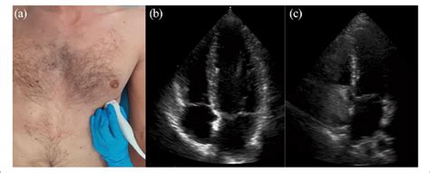 Transthoracic Apical Four Chamber View Placement Of The Probe A