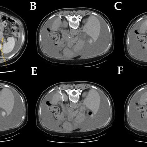 Computed Tomography Ct Guided Core Needle Biopsy Images Via Detour Download Scientific