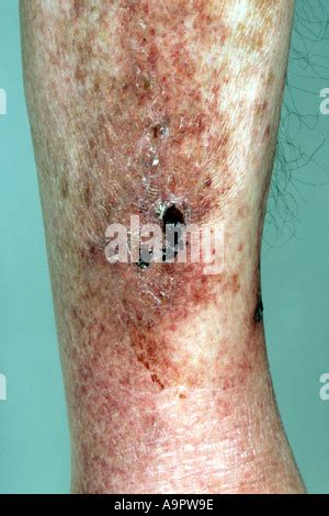 Scurvy rash Stock Photo - Alamy